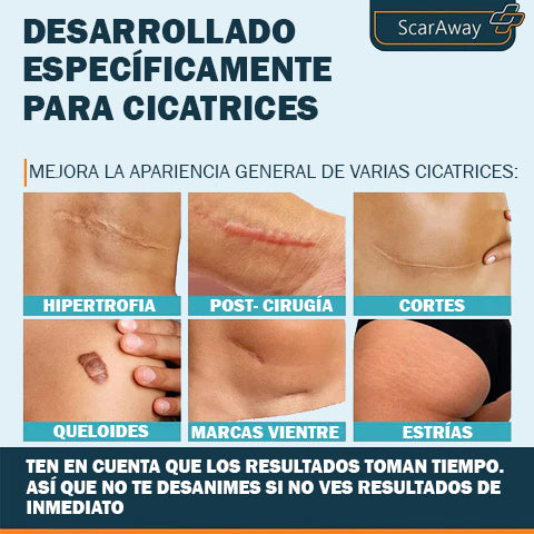 ScarAway Professional Gel - Cesárea, abdominoplastia, cicatrices, estrías, cicatrices de quemaduras.